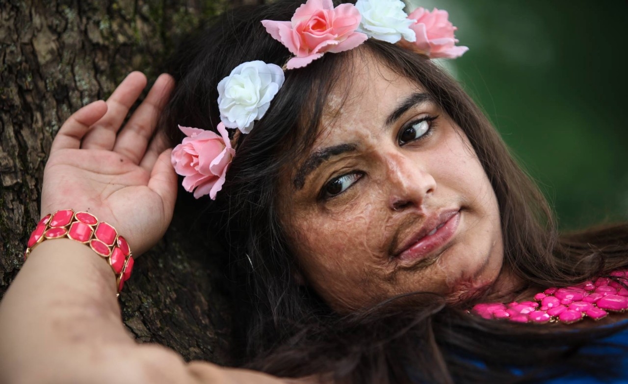 Acid-attack survivor Prerna Gandhi poses for a photo shoot.